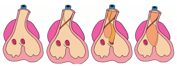 IV-Septum-Devo.png