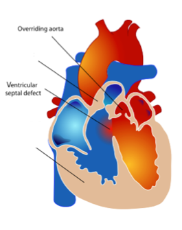 Overriding-aorta-VSD.png