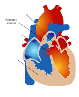 Pulmonary-stenosis-fallot.png