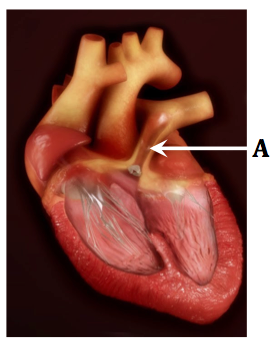 Pulmonary-stenosis.png