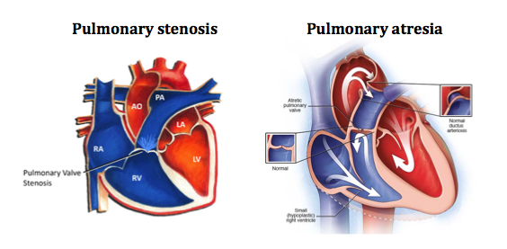 Stenosis-vs-atresia.png