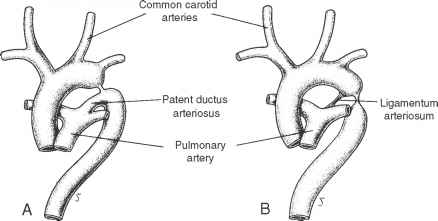 ductus-arteriosus-ligamentum.jpg