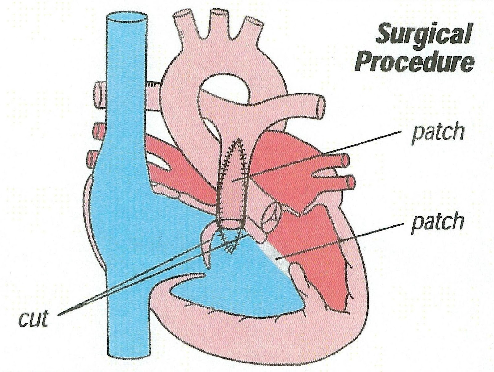 tetralogy_surgery.jpg